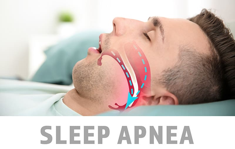 Sleep Apnea treatment in Jacksonville, NC